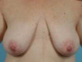 Patient # 16733 Before Photo # 1